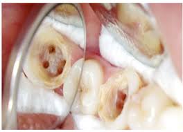 Macamana nak hilangkan sakit gigi ni!. Yang Giginya Berlubang Baca Ini Jangan Tampal Atau Cabut Ini Caranya Teman Teman Kena Tahu My Info Maya