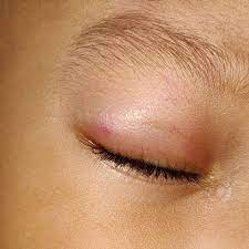 Maybe you would like to learn more about one of these? My Eight Month Baby Right Eyelid Swell May Be Its A Rain Bug Bite What To Do Firstcry Parenting