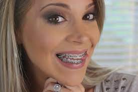 Adult Braces Update 8 Month 11 Expanders Elastics