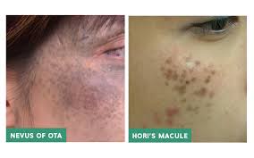 Pigmentation Removal In Singapore Dr Wong Soon Tee