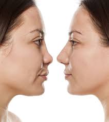 You might have surgery because you're unhappy with the way your nose looks or you may want to restore its shape after an injury. Opt For A Safer Procedure To Reshape Or Improve Your Nose By Considering The Rhinoplasty Nose Surgery In Uk Lo Rhinoplasty Nose Surgery Rhinoplasty Nose Jobs