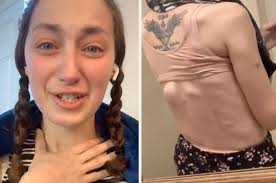 Có nốt ruồi lớn quá khổ trên người, cô gái trẻ mặc kệ bỏ qua, 3