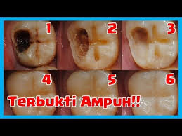 Salah satu resep tradisional nenek moyang untuk menghilangkan sakit gigi adalah minyak cengkeh. Cara Mengobati Sakit Gigi Yg Ampuh Bisabo Channel