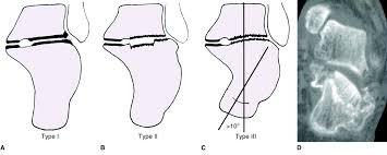 Image result for Calcaneus Compression Fracture