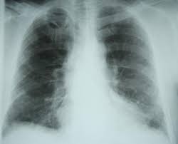 Aceasta apare, de obicei, după ce pacientul a suferit o pneumonie și prezintă o cicatrice în interiorul plămânilor. Fibroza PulmonarÄ IdiopaticÄ O BoalÄ VersatilÄ Èi MisterioasÄ