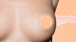 How long do breast implants last saline. Breast Implants Everything You Need To Know Glamour