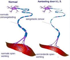 Amyotrophic lateral sclerosis (als) is a progressive neurological disease that destroys nerve cells in the brain and the spinal cord and causes disability. Amyotrofische Lateraal Sclerose Als A L S Gezondheid Be