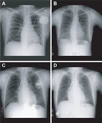 Does it give you shocks? Plos One Novel Extraction Technique Of Retained Pacemaker And Defibrillator Lead During Heart Transplantation