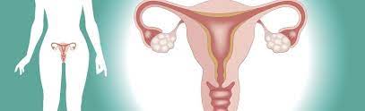 Leur diagnostic a d'autant plus de chance d'être précoce que la personne concernée est suivie régulièrement par un gynécologue. Kyste Ovarien Definition Causes Symptomes Traitement