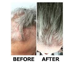 This type of hair loss is most often temporary. Hair Loss Hair Loss Treatments Bergen County Hair Loss