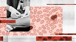Image result for Drug Induced Platelet Dysfunction