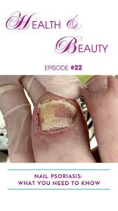 Image result for Pitting nails feet