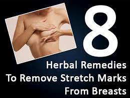 8 Herbal Remedies To Remove Stretch Marks From Breasts Boldsky Com