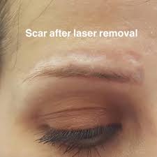After the process, your eyebrows will look darker and may feel tender. Saline Removal Of Microblading And Tattoo Los Angeles Boleyn Studio