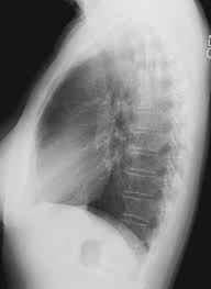 Image result for Chest XRay