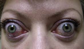 Image result for Proptosis