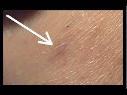 They produce raised red spots which can sometimes become infected. Electrolysis On Ingrown Hairs Step By Step Youtube