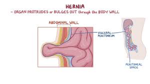 A hernia usually develops between your chest and hips. Hernias Clinical Practice Osmosis