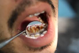 Image result for dental cancer