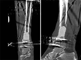 Wide diaphyseal bone defects, above all those infected, encounter into masquelet technique a suitable treatment. Die Masquelet Technik Zur Behandlung Grosser Dia Und Metaphysarer Knochendefekte Springerlink