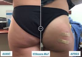 L'augmentation des fesses ou la chirurgie des fesses, est une intervention qui vise à remodeler le fessier. Galber Vos Fesses Grace A L Injection D Acide Hyaluronique Paris Cshp