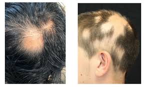 Image result for Alopecia