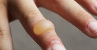 وصفات طبيعية لعلاج الحروق البسيطة ويب طب