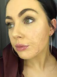 Young teacher, 24, nearly quits over severe acne which left trolls  'spitting out dinner'