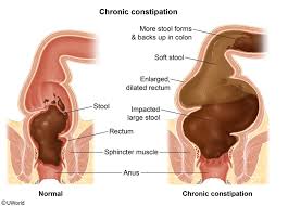 Image result for Pediatric Constipation