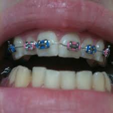 Black And Light Blue Braces Light Blue Baby Pink Baby Pink Pink Beaded Bracelets