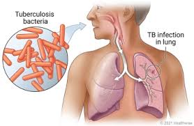 Image result for Tuberculosis
