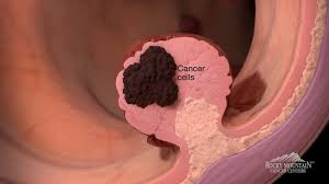 Image result for Colorectal Cancer