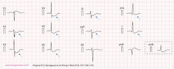 Maybe you would like to learn more about one of these? St Segment Depression In Myocardial Ischemia And Differential Diagnoses Ecg Echo