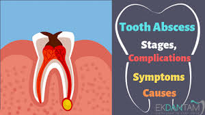 However, this is rarely the only treatment advised. Tooth Abscess Stages Complications Symptoms And Causes Ekdantam Clinic