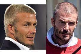 @noah, look carefully at the photo 3 and tell me if that is not a hair system. David Beckham Hair Loss Investigating The Facts Nicehair Org