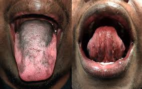 Image result for black tongue symptoms