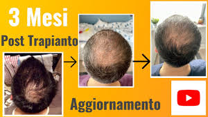 If you need to find your local post office, it's easier than ever before. Aggiornamento 3 Mesi Dopo Il Trapianto Di Capelli Youtube