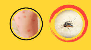 Changes in consciousness ranging from mild (sluggishness) to severe (mental confusion, convulsions, or coma). West Nile Virus Rash Symptoms Diagnosis Best Treatment