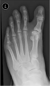 Image result for Hallux Varus