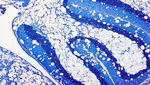 Canavan Disease