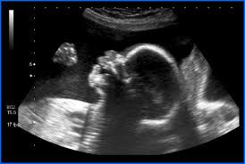 Dating/viability scan establishing an estimated due date early on in pregnancy is of vital importance, as this date is then used for the rest of the pregnancy to determine when the baby is likely be born. Dating Scan Only 89 No 1 Uk Pregnancy Scan Provider Book Now