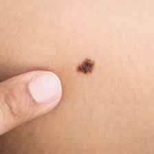 Clínicamente, las verrugas malignas son denominadas neoplasias cutáneas, y se trata de unos pequeños abultamientos de la piel de un pequeño tamaño. Verrugas Causas Tratamientos Y Extraccion