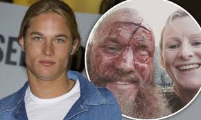 Check spelling or type a new query. Former Calvin Klein Model Travis Fimmel Sports Very Sports Bloody Gash In Vikings Photo Daily Mail Online