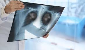 It is the leading cause of cancer death in both men and women. Lung Cancer Cases Missed As Symptoms Mistaken For Covid Thousands More Died Express Co Uk