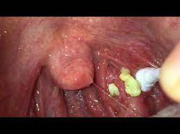 They aren't that difficult to remove. Meet The Bizarre Reddit Community Obsessed With Digging Out Tonsil Stones On Camera The Independent The Independent