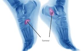 Pain from bone tumors can originate from within the bone. Fighting Bone Cancer Symptoms Diagnosis Treatments