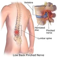 How to sleep with herniated disc in upper back. Spinal Disc Herniation Wikipedia