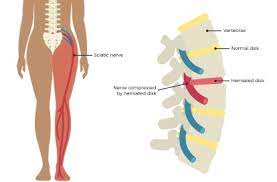 Sciatica During Pregnancy
