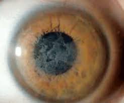Pathologic studies show abnormal, redundant basement membrane and intraepithelial lacunae filled with cellular debris. Ic3d Classifying Corneal Dystrophies