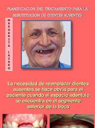 Planificacion Del Tratamiento para La Sustitucion de Dientes Ausentes